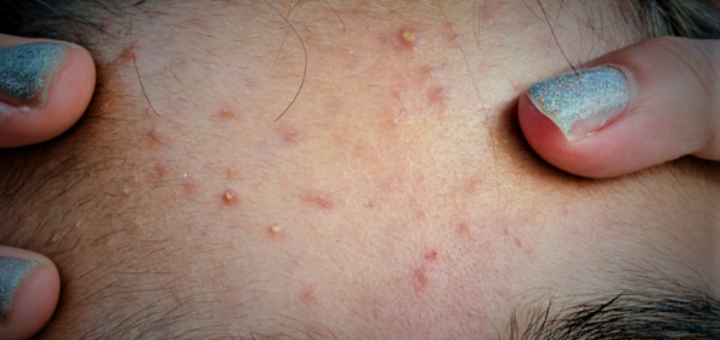What are the causes of getting acne? How does one get rid of it?