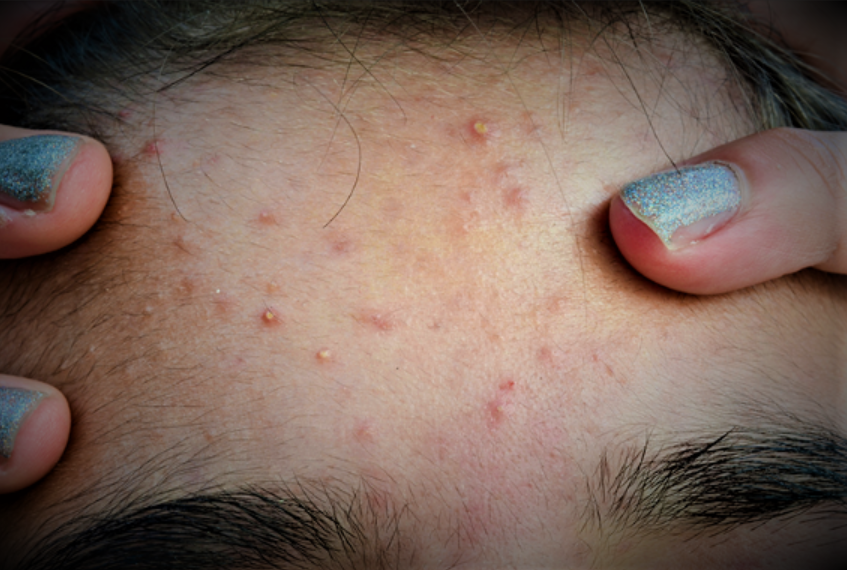 What are the causes of getting acne? How does one get rid of it?